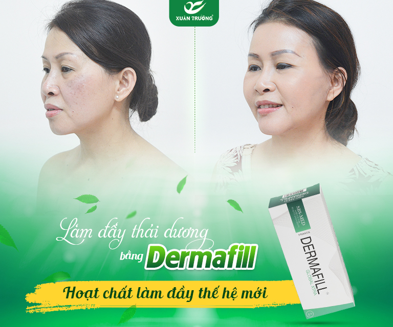 Dermafill – Hoạt chất làm đầy “thế hệ thứ 4”
