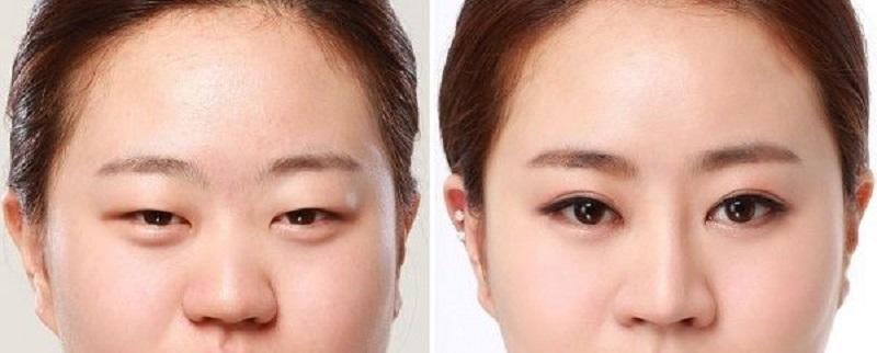 Thẩm mỹ nào nhấn mí giá rẻ lại còn uy tín? 