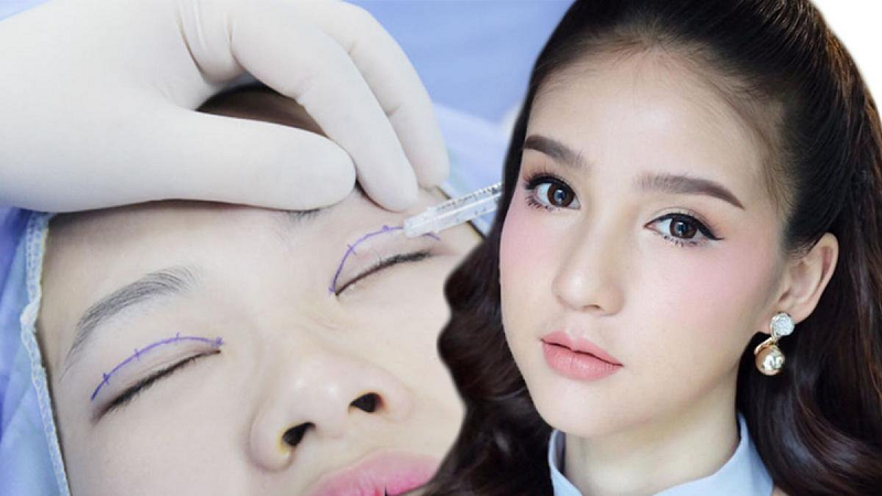 Nhấn mí giá bao nhiêu? Có đau và ảnh hưởng gì không?