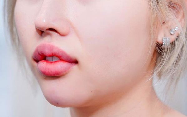4 Nguyên nhân khi tiêm filler môi bị vón cục bạn cần biết