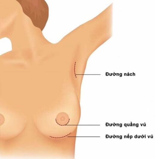 15 nang nguc duong quang 1 nâng ngực đường quầng