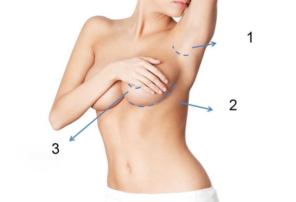 15 nang nguc duong quang 2 nâng ngực đường quầng 2