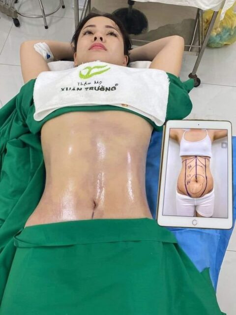 triệt mỡ bụng 6