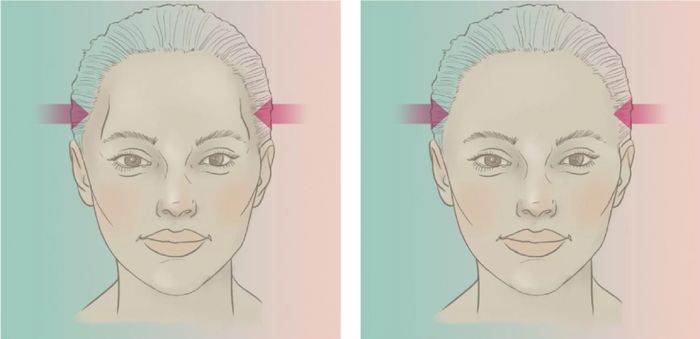 Thái dương lõm trước và sau khi cấy mỡ