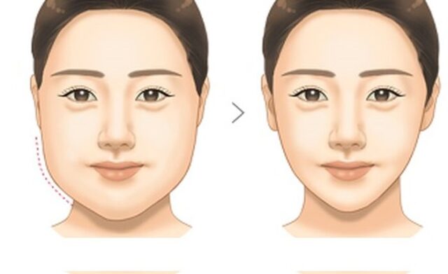 130.1 giam mo mat hieu qua Giảm mỡ mặt hiệu quả