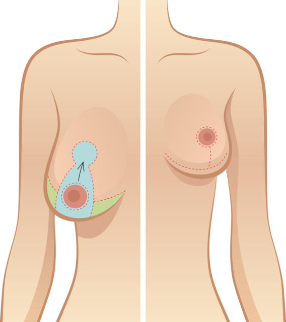 Thu nhỏ ngực phì đại 3