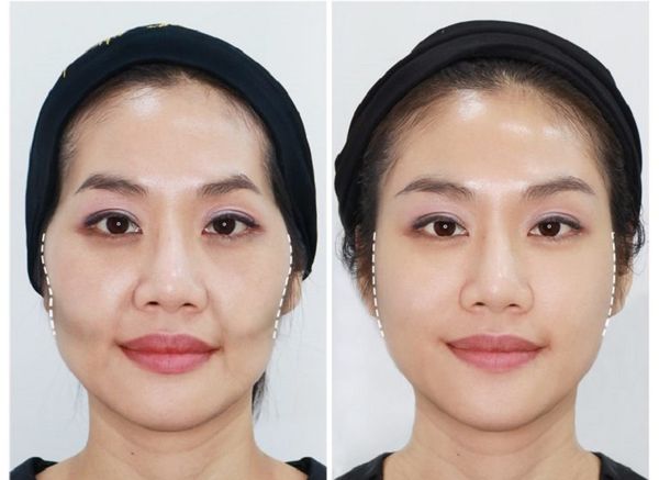 13 hop thai duong bam sinh 2 hóp thái dương bẩm sinh 2
