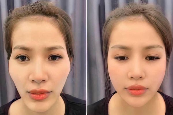 13 hop thai duong bam sinh 3 hóp thái dương bẩm sinh 5