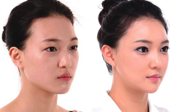 13 hop thai duong bam sinh 4 hóp thái dương bẩm sinh 6
