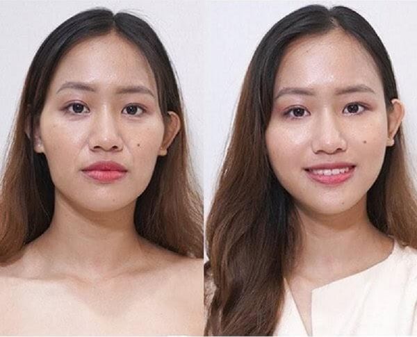 13 hop thai duong bam sinh 5 hóp thái dương bẩm sinh 7