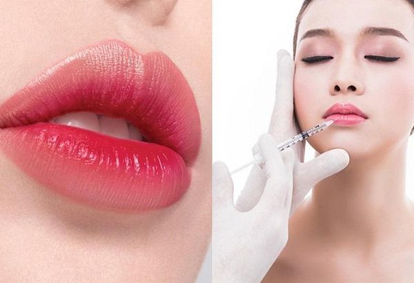 Tiêm filler môi tự nhiên gợi cảm 2