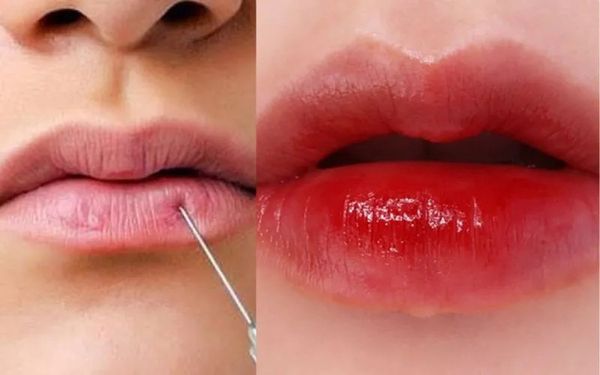 Tiêm filler môi an toàn với cơ sở uy tín