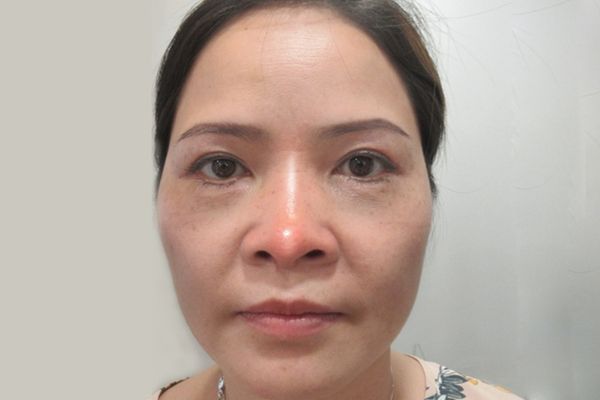 6 hau qua cua nang mui khi ve gia 1 Hậu quả của nâng mũi khi về già