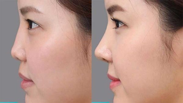 Mũi tẹt thành mũi cao