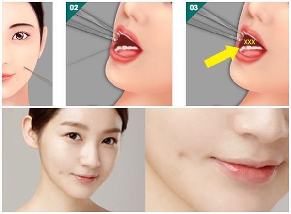tạo má lúm đồng tiền