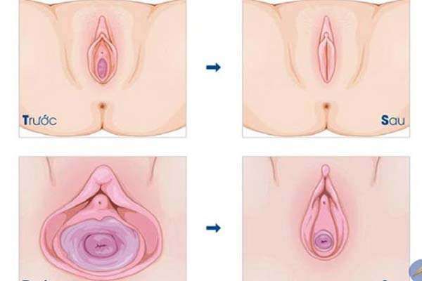 24 co be bi rong thi phai lam sao 2 1 Địa chỉ thẩm mỹ cấy mỡ vùng kín chuyên nghiệp