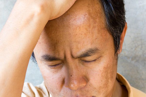 da mat sam den o nam gioi Da mặt sạm đen ở nam giới