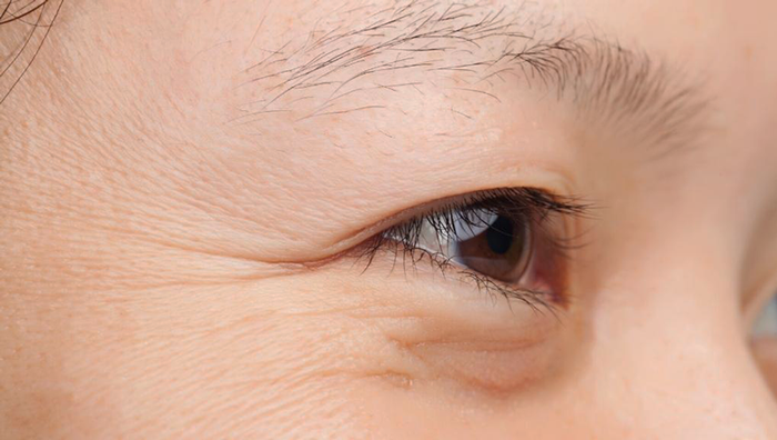 Xóa nhăn đuôi mắt tại TPHCM