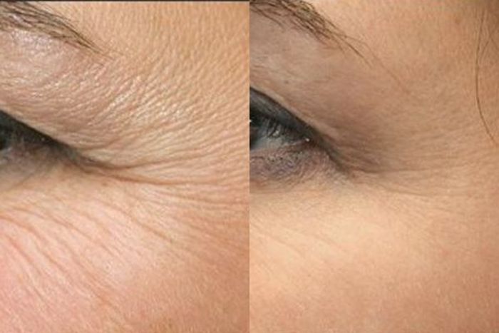 Xóa nhăn đuôi mắt tại TPHCM 3