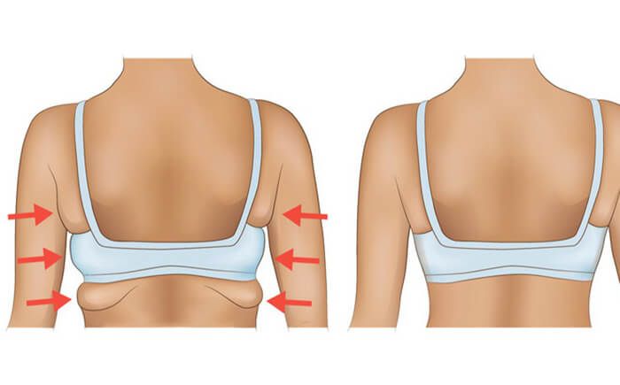 Triệt mỡ lưng tại TPHCM 2