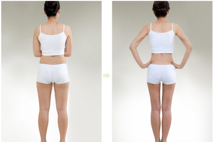 Triệt mỡ lưng tại TPHCM 6