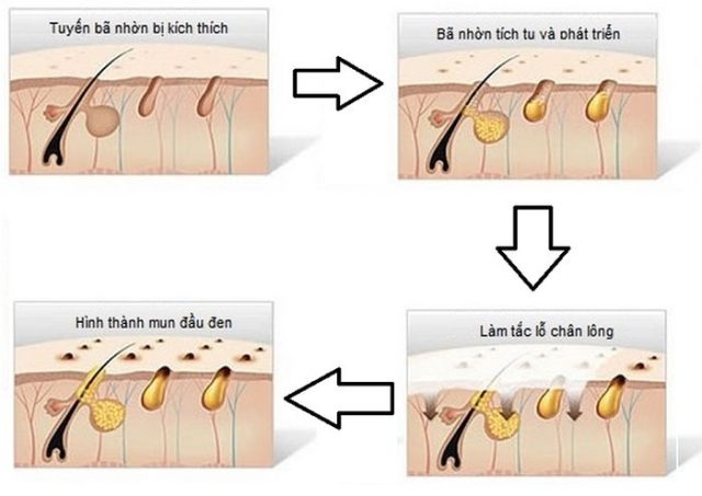 trị mụn dứt điểm 2