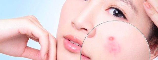trị mụn dứt điểm 3
