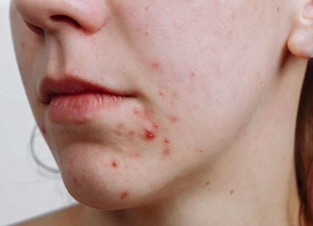 Xuân Trường chính là viện thẩm mỹ giúp trị mụn dứt điểm