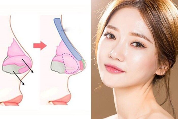 53 Gia nang mui boc sun 2 Giá nâng mũi bọc sụn 4