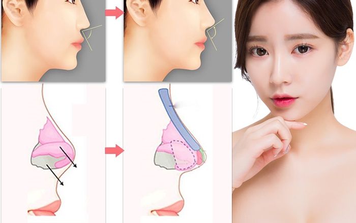 53 Gia nang mui boc sun Giá nâng mũi bọc sụn