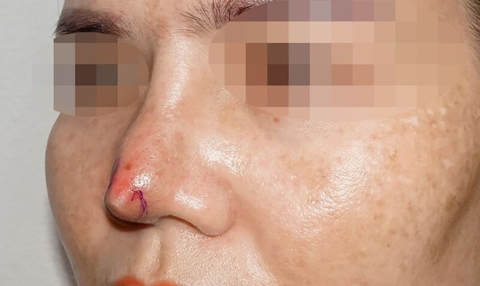 56 mui hong sau nang 4 mũi hỏng sau nâng 4