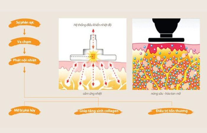 57 Laser lay mo noi soi 1 Laser lấy mỡ nội soi 1