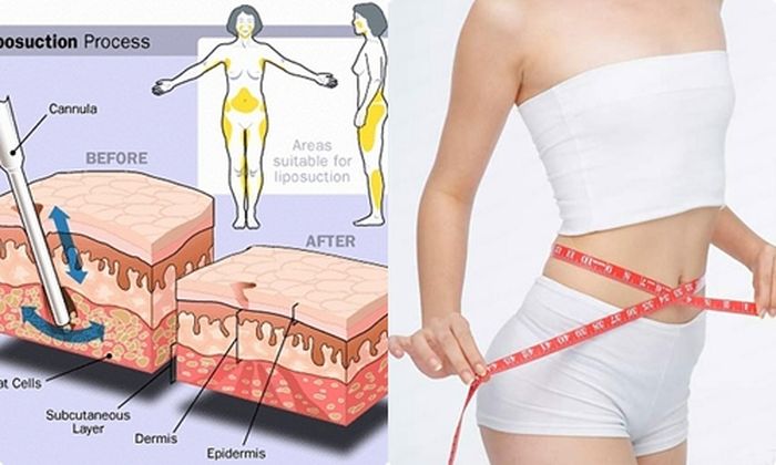 Laser lấy mỡ nội soi 2