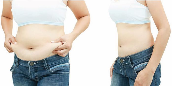 57 Laser lay mo noi soi 4 Laser lấy mỡ nội soi 4