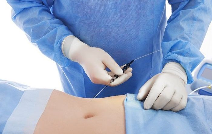 65 mo bung duoi 3 mỡ bụng dưới 3