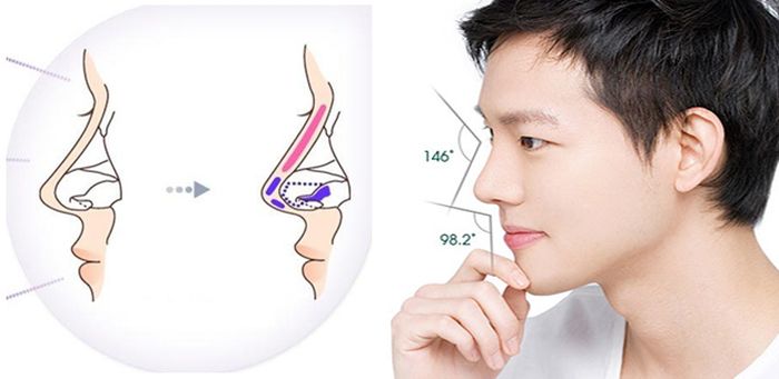 nang mui s line danh cho nam 4 Nâng mũi S Line dành cho Nam 4