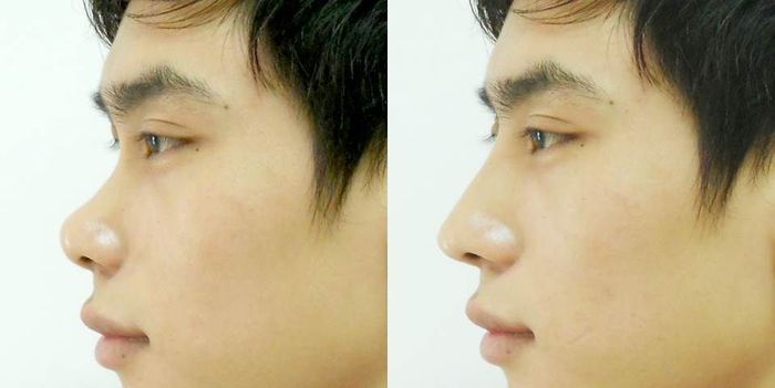 nang mui s line danh cho nam Nâng mũi S Line dành cho Nam 1