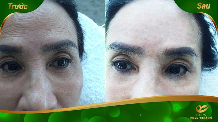 cách xóa vết nhăn trên trán 2