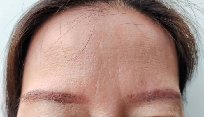 cách xóa vết nhăn trên trán 3