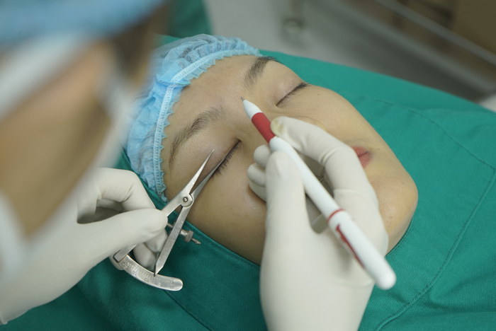cắt mí đẹp TPHCM1