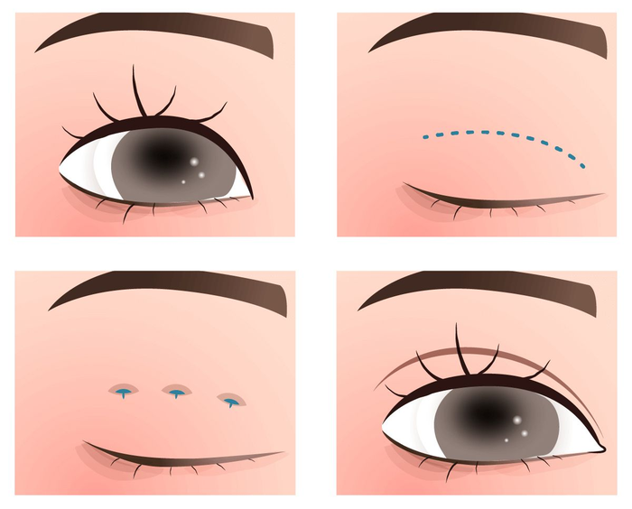 cắt mí đẹp TPHCM 2