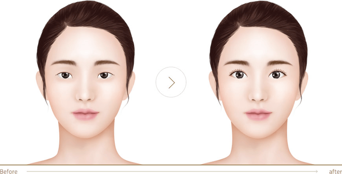 cắt mí đẹp TPHCM 7