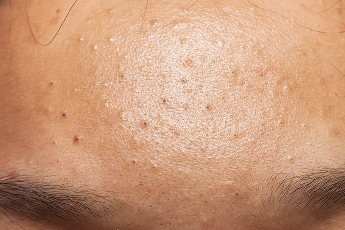cách trị mụn sau sinh 9