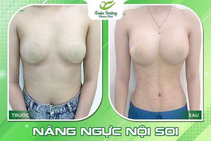 02 nang nguc noi soi 3 nâng ngực nội soi 3