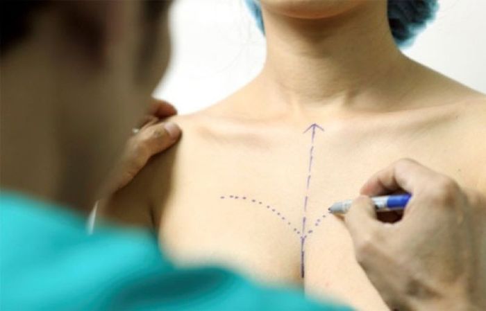 02 nang nguc noi soi 6 Xuân Trường Plasma Clinic đảm bảo không biến chứng,