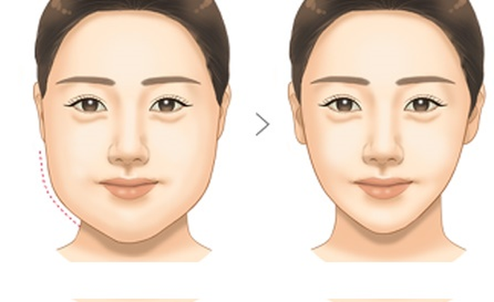 Giảm mỡ mặt nhanh chóng hiệu quả cao giúp khuôn mặt thanh thoát