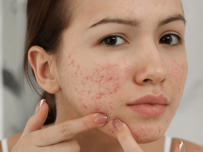 Bị nhiều mụn 3