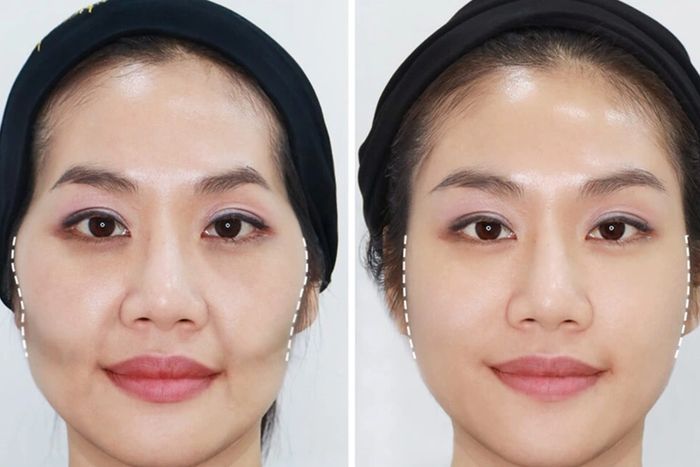 132 mat gay ma hop 1 mặt gầy má hóp 1
