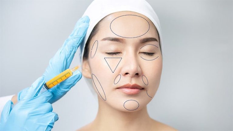 Cay mo tu than giup cai thien cac khuyet diem va tre hoa khuon mat