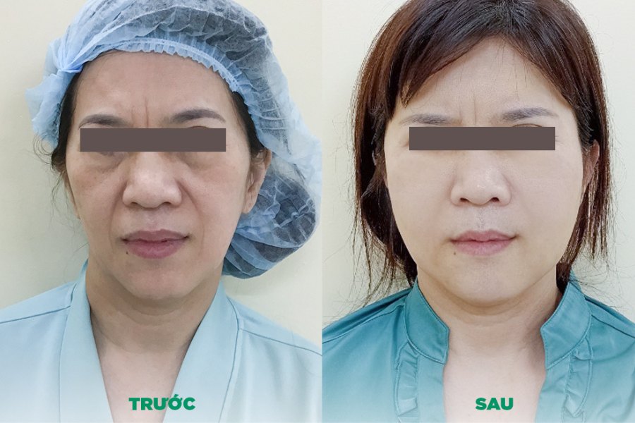 Cấy mỡ tự thân giúp cải thiện đáng kể những khuyết điểm trên khuôn mặt khách hàng